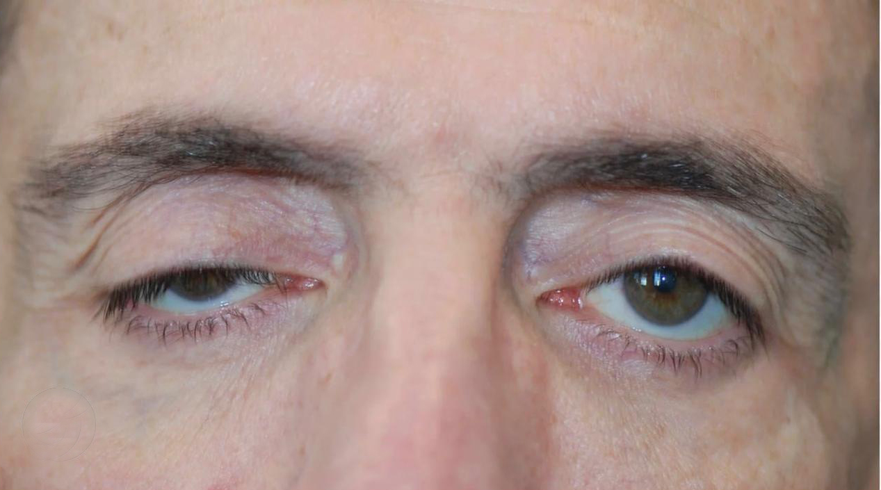 A importância da boa relação médico-paciente na cirurgia de correção da ptose palpebral